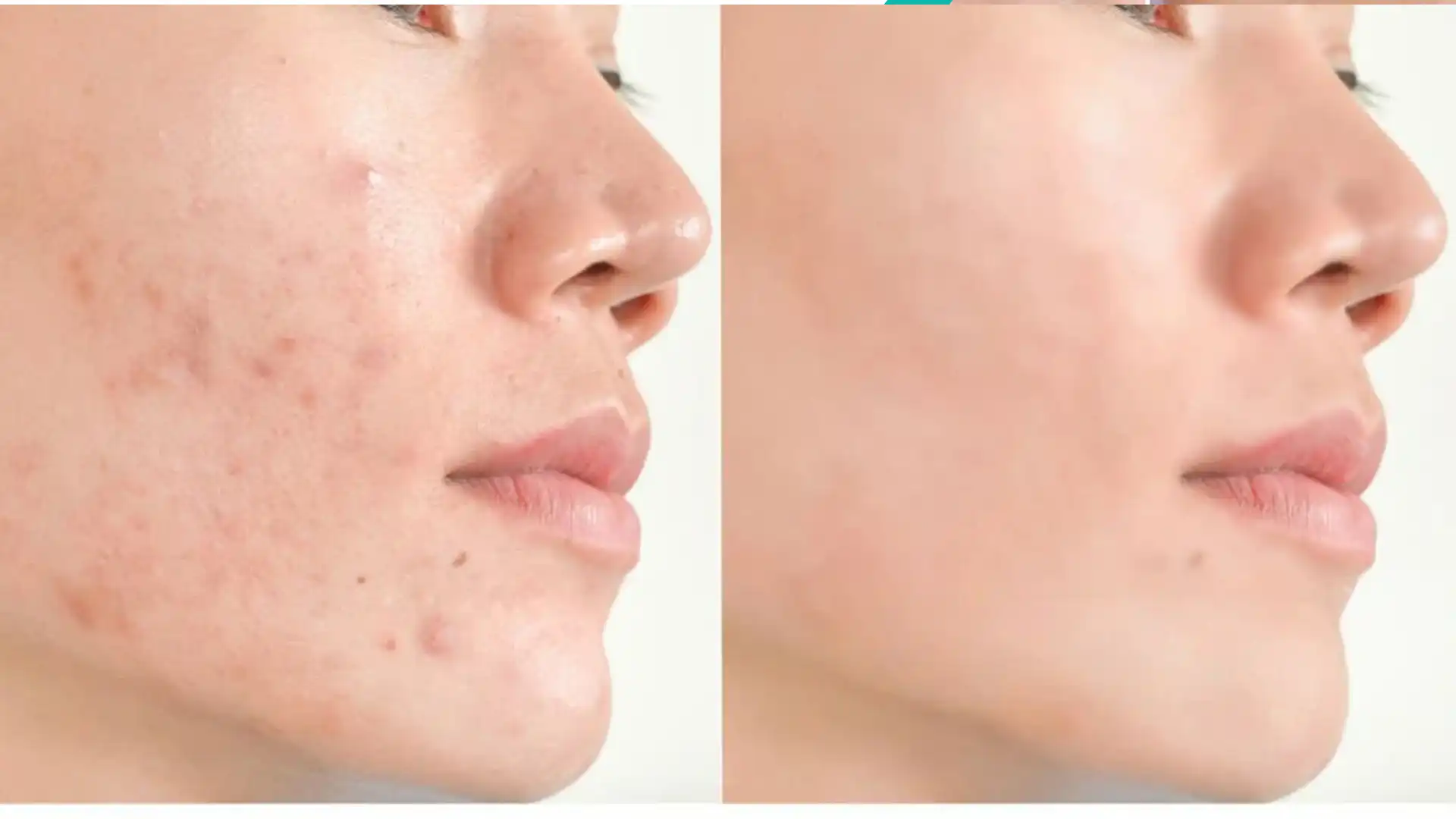 How Long Does It Take for Acne Spots to Remove