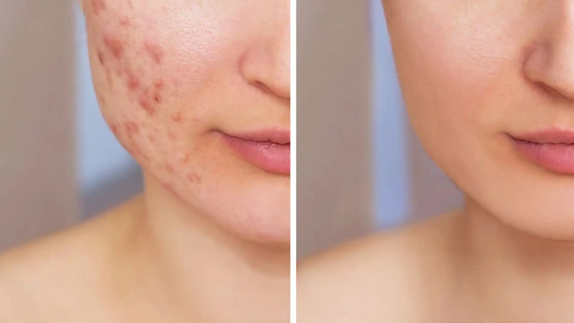 How to Remove Acne Spots Naturally at Home