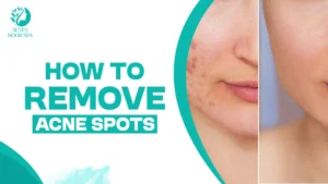 How to remove acne spots
