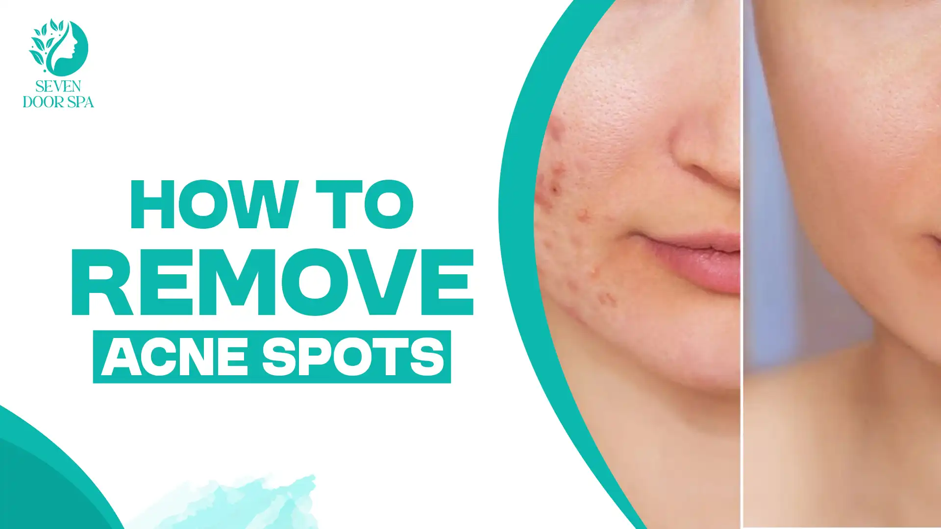 How to remove acne spots